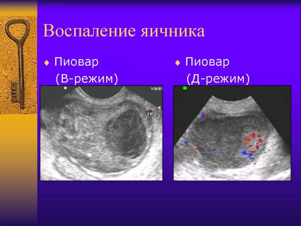 Какие заболевания яичников. УЗИ воспаленного яичника. Воспалительные заболевания яичников.