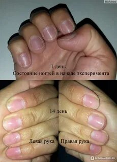 Смарт от онихолизиса ногтей