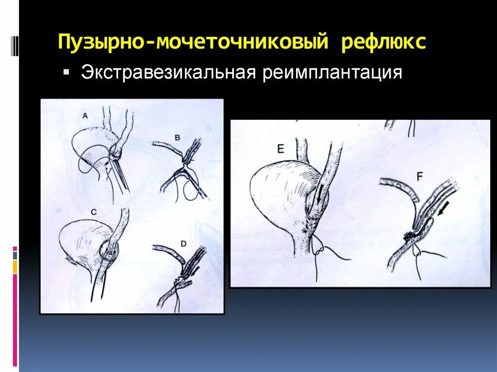 Рефлюкс мочеточника. Пузырно-мочеточниковый рефлюкс механизм. Пузырно-мочеточниковый рефлюк. Пузырно лоханочный рефлюкс. Пузырно мочеточниковый рефлюкс операция.