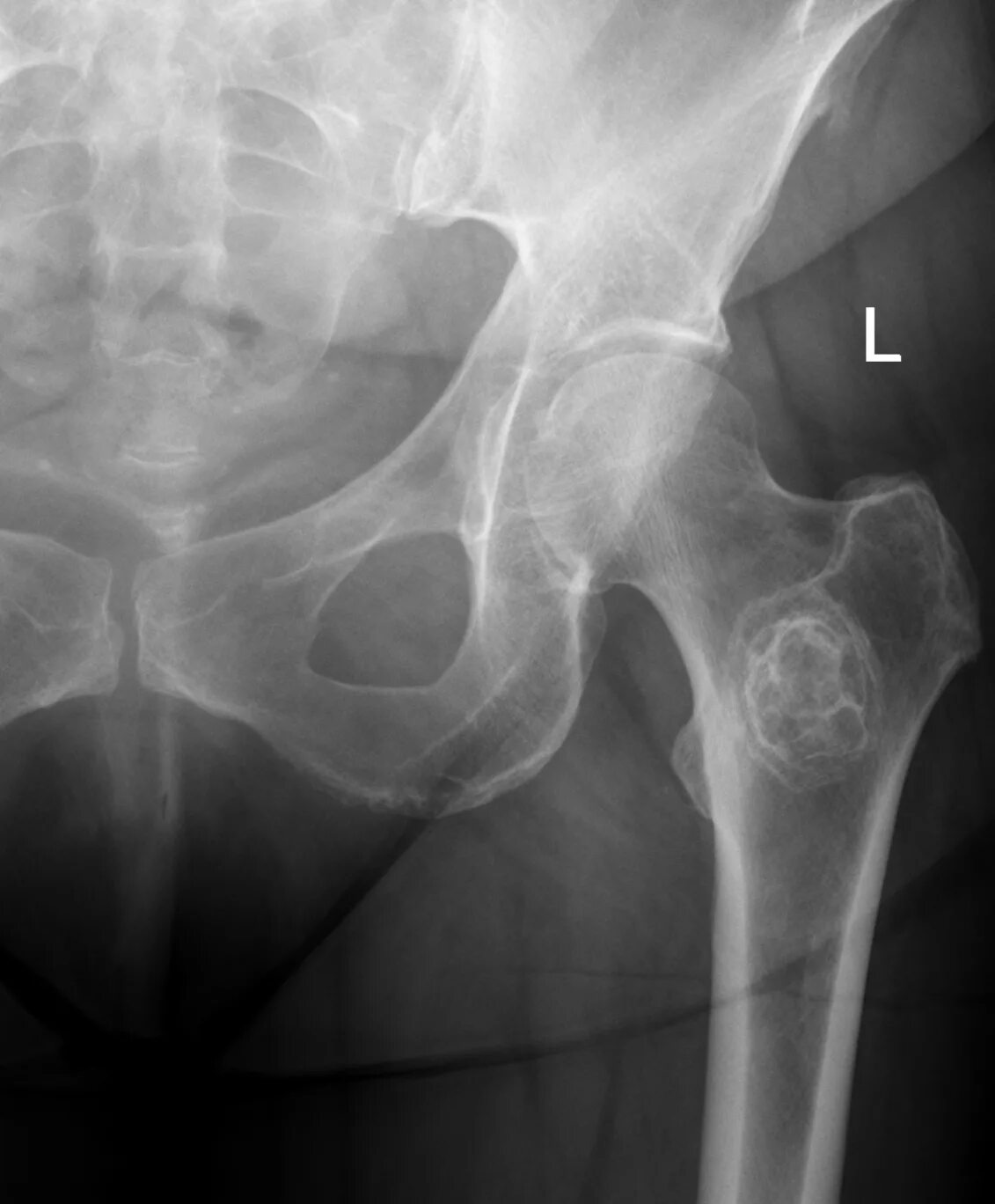 Саркома тазобедренного. Остеома кости тазобедренного сустава. Остеоид-остеома бедренной кости рентген. Саркома подвздошной кости рентген. Остеома головки бедренной кости.