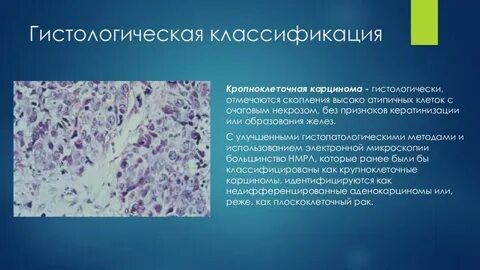 Виды карциномы