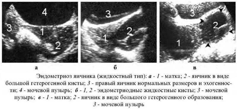 Кисты яичников классификация УЗИ. Эндометриоз яичников на УЗИ. Эндометриоидная киста шейки матки на УЗИ. УЗИ диагностика эндометриоидной кисты. На узи видно рак шейки