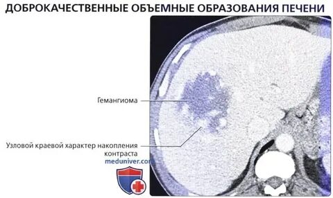 Накопление контраста в печени