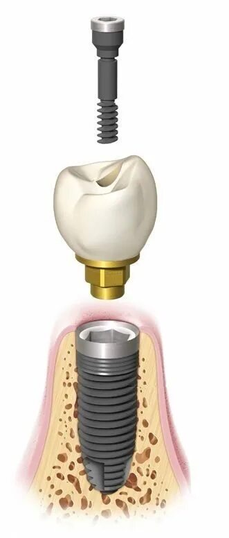 винтовая фиксация имплантата. винтовая коронка абатмент. имплантаты double medical педикулярные винты. имплант винт абатмент коронка. имплант винтовой как выглядит.