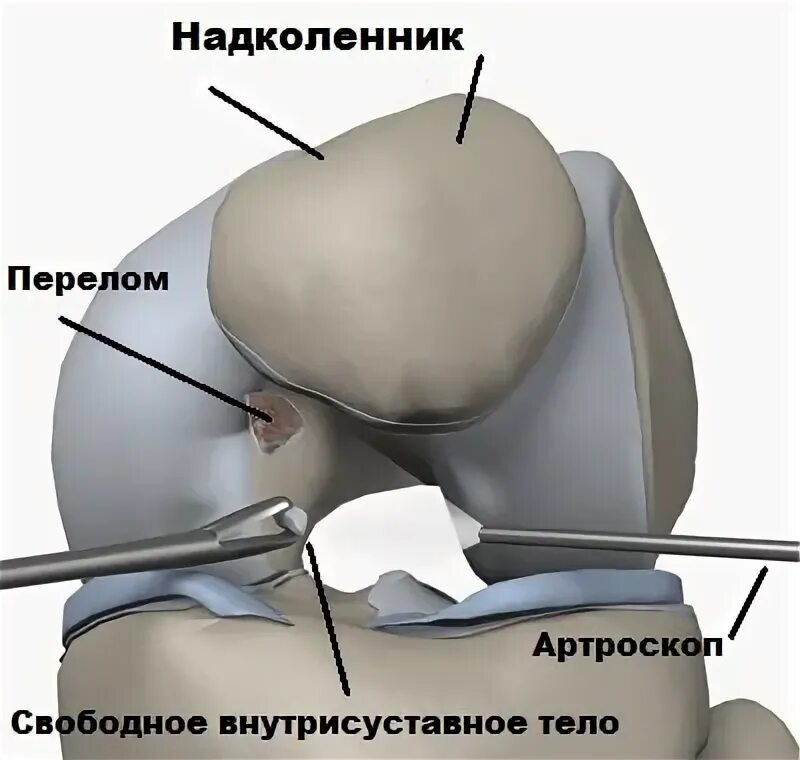 Артроскопия надколенника. Медиальный вывих надколенника. Вывих надколенника артроскопия. Надколенника перелом латеральный. Перелом надколенника операции