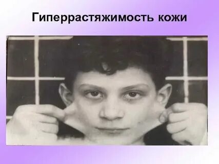 Соединительная ткань у ребенка
