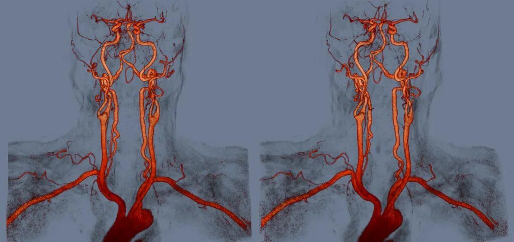 V4 сегмент позвоночной артерии. Интракраниальные сегменты позвоночной артерии. Коллатерали позвоночной артерии. Позвоночная артерия анатомия.