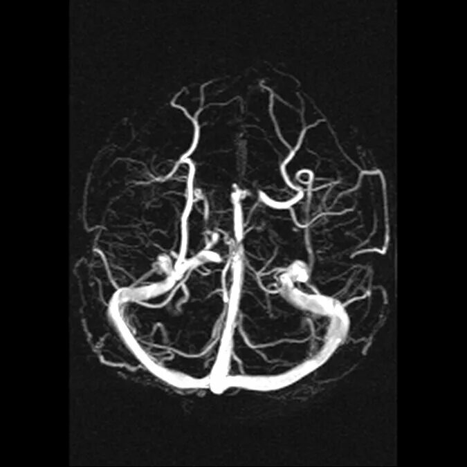 Венография головного мозга. Ангиография вен головного мозга. Кт ангиография головного мозга. Магнитно-резонансная ангиография артерий головного мозга. Кт ангиография и мрт сосудов головного мозга.