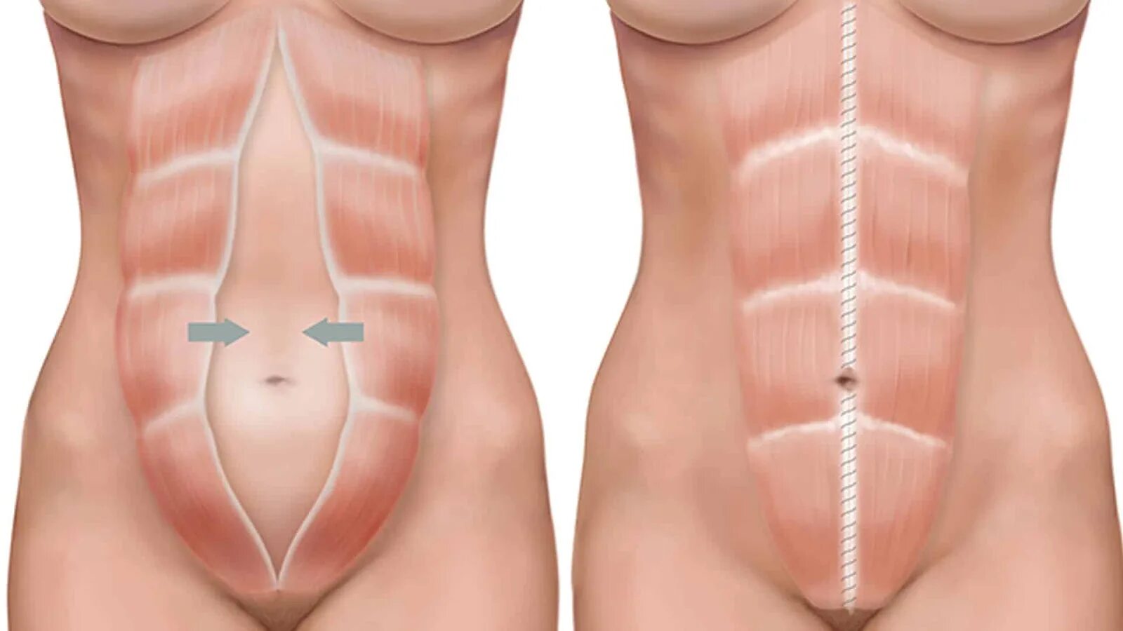 Прямая мышца живота у женщин. Диастаз мышц передней брюшной. Диастаз (расхождение краев прямой мышцы живота),.
