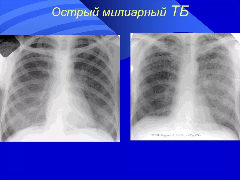 Острый диссеминированный туберкулез. Острый диссеминированный туберкулез рентген. Острый диссеминированный туберкулез легких рентген. Милиарный туберкулез рентген. Милиарный диссеминированный туберкулез.