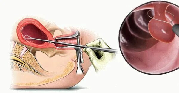 Выскабливание полости матки полип. Полип эндометрия гистероскоп. Гистероскопия с выскабливанием. Гистероскопия полипэктомия. Выскабливание как проводится