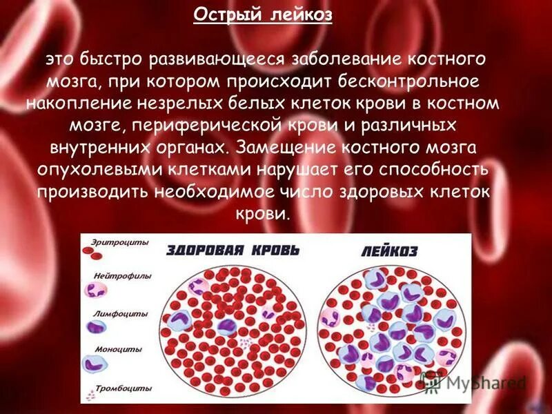 Острый лимфобластный лейкоз кровь. Leikoz. Болезнь крови лейкемия.
