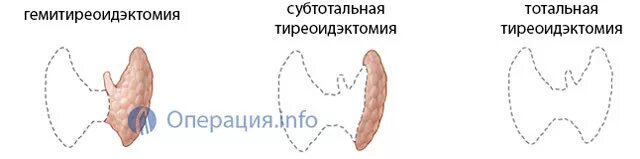 Сколько длится операция щитовидной. Гемитиреоидэктомия щитовидной железы схема. Тиреоидэктомия методика операции. Осложнения операций щитовидной железы. Субтотальная резекция щитовидной железы схема.