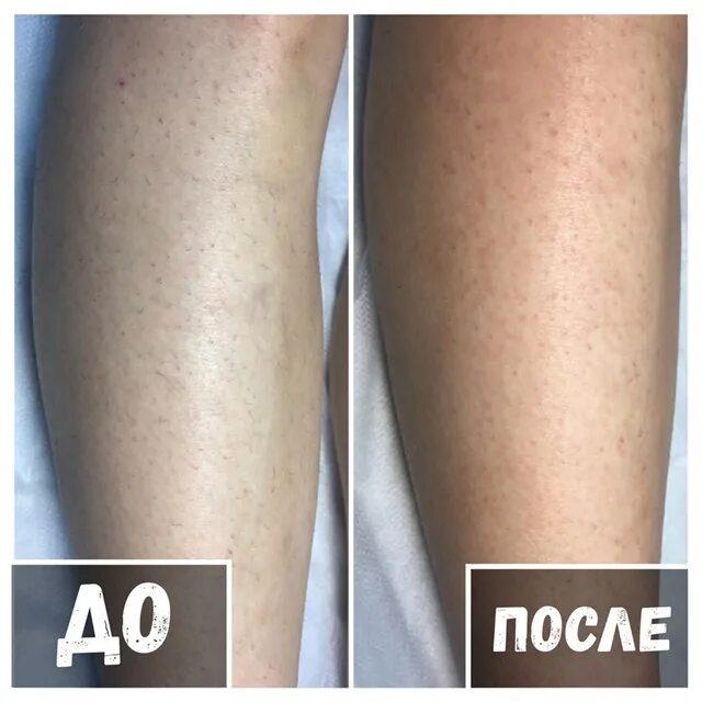 Почему нельзя делать лазерную эпиляцию
