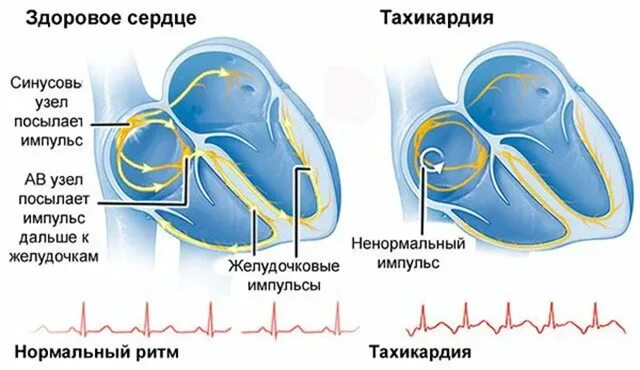 Тахикардия. Тахикардия сердца. Заболевание сердца тахикардия. Усиление сердцебиения.