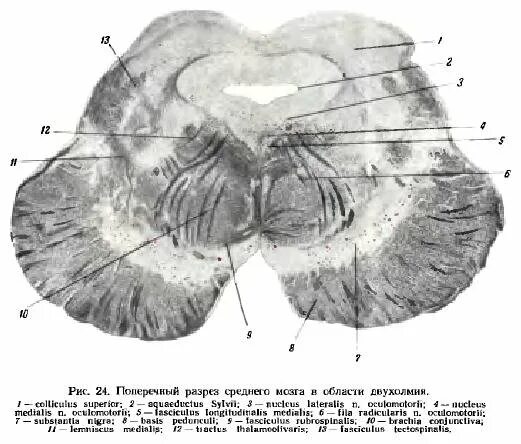 Спайки головного мозга. Средний мозг ретикулярная формация. Поперечный срез среднего мозга. Ретикулярная формация гистология. Ретикулярная формация на срезе среднего мозга.