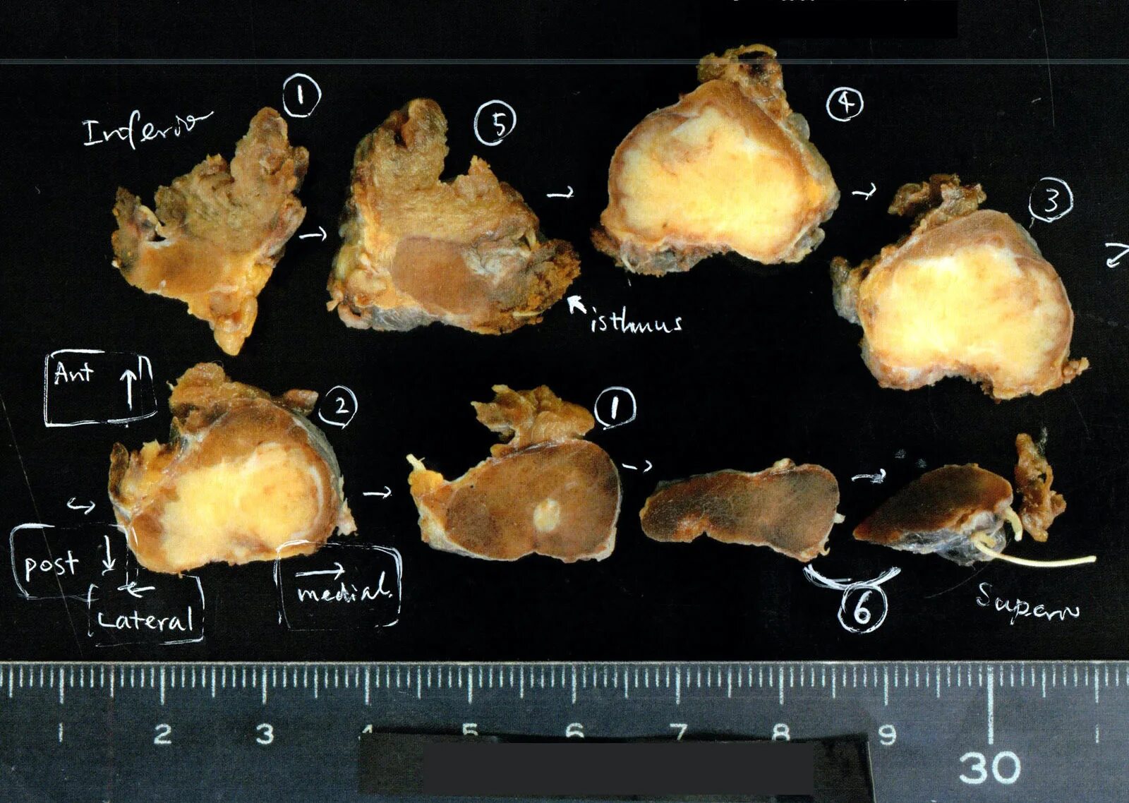 Объемы опухоли. Tall crll papillary Thyroid carcinoma Pathology outlines. Wartin like papillary Thyroid carcinoma Pathology outlines.