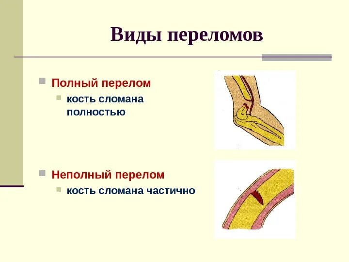 Перелом кости может быть каким. Полный и неполный перелом. Полный и не полный передом. Полные и не полнеые переломы. Полный и частичный перелом.