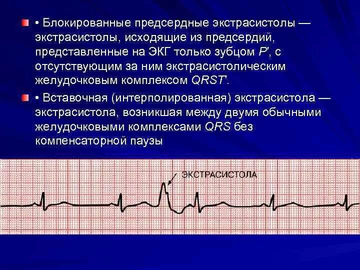 Блокированная желудочковая экстрасистолия на ЭКГ. Блокированные желудочковые экстрасистолы на ЭКГ. Желудочковые экстрасистолы на ЭКГ. Блокированная суправентрикулярная экстрасистолия ЭКГ. Блокированные экстрасистолы