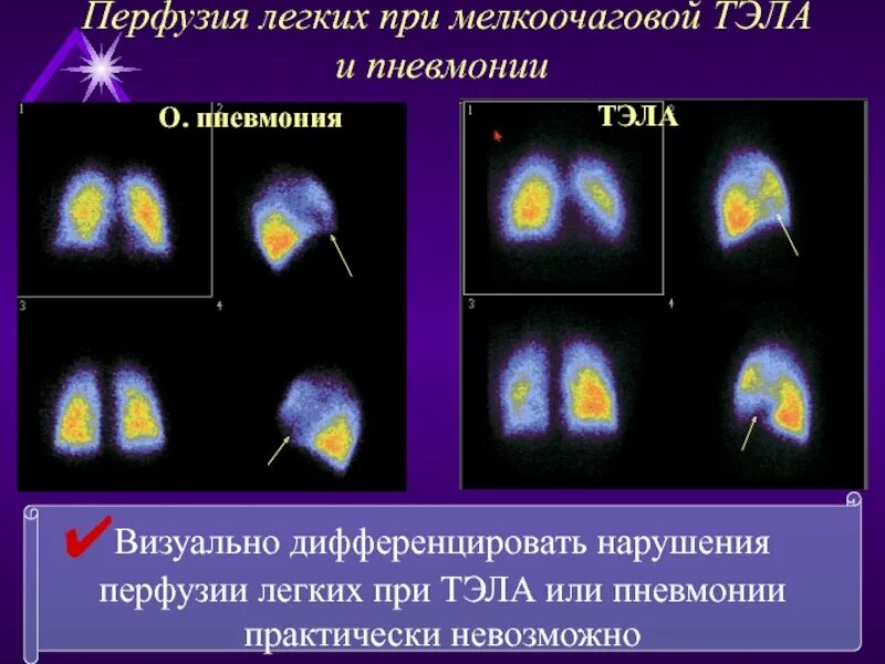 Поражение легкого 50. Нарушение перфузии легких. 70 Процентов поражения легких.