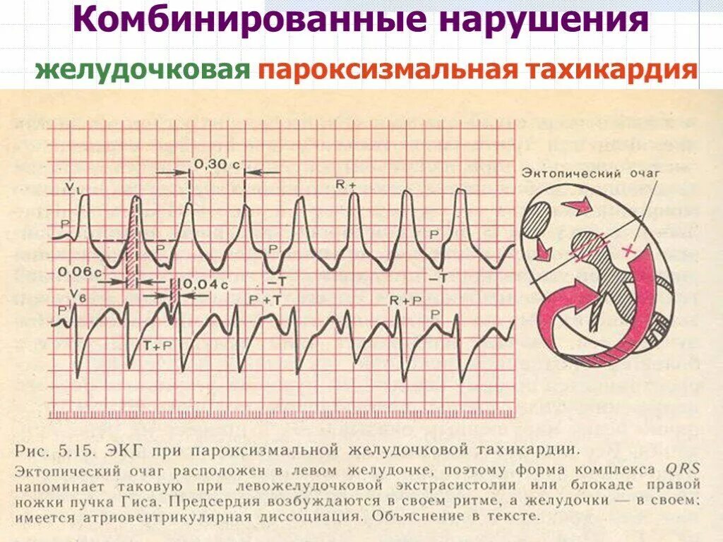 Желудочковая тахикардия на экг. Пароксизмальная желудочковая тахикардия на ЭКГ. ЭКГ при желудочковой пароксизмальной тахикардии. Пароксизмальная тахикардия желудочков ЭКГ. Суправентрикулярная и желудочковая тахикардия.