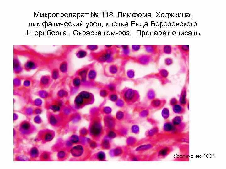 Клетки рида. Клетки Рида – Штернберга препарат. Лимфома Ходжкина клетки Березовского-Штернберга-Рид. Лимфома Ходжкина гистология. Клетки Березовского-Штернберга гистология.