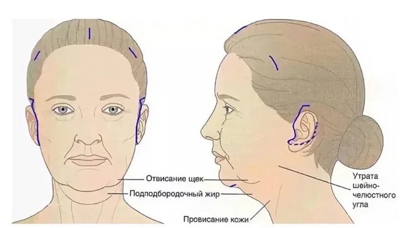 Смас лифтинг схема операции. Круговая подтяжка лица схема. Брыли схема. Брыли на лице схема. Схема подтяжки лица