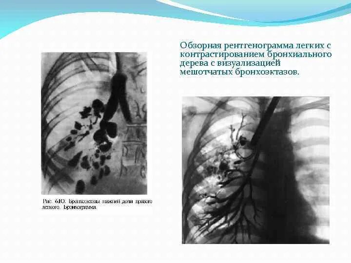 Бронхит и бронхоэктатическая болезнь. Симптомы характерные для бронхоэктатической болезни. Бронхоэктатическая болезнь аускультативная картина. Бронхоэктатическая болезнь грудная клетка. Бронхоэктатическая болезнь легких рентген.