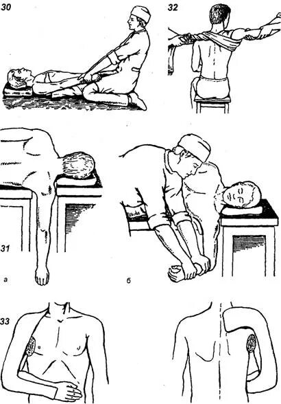 Лечение плеча после вправления. Вправление вывиха метод Гиппократа. Методы вправления плечевого сустава. Вывих плечевого сустава вправление по Гиппократу. Вправление вывиха плеча по Гиппократу Куперу.