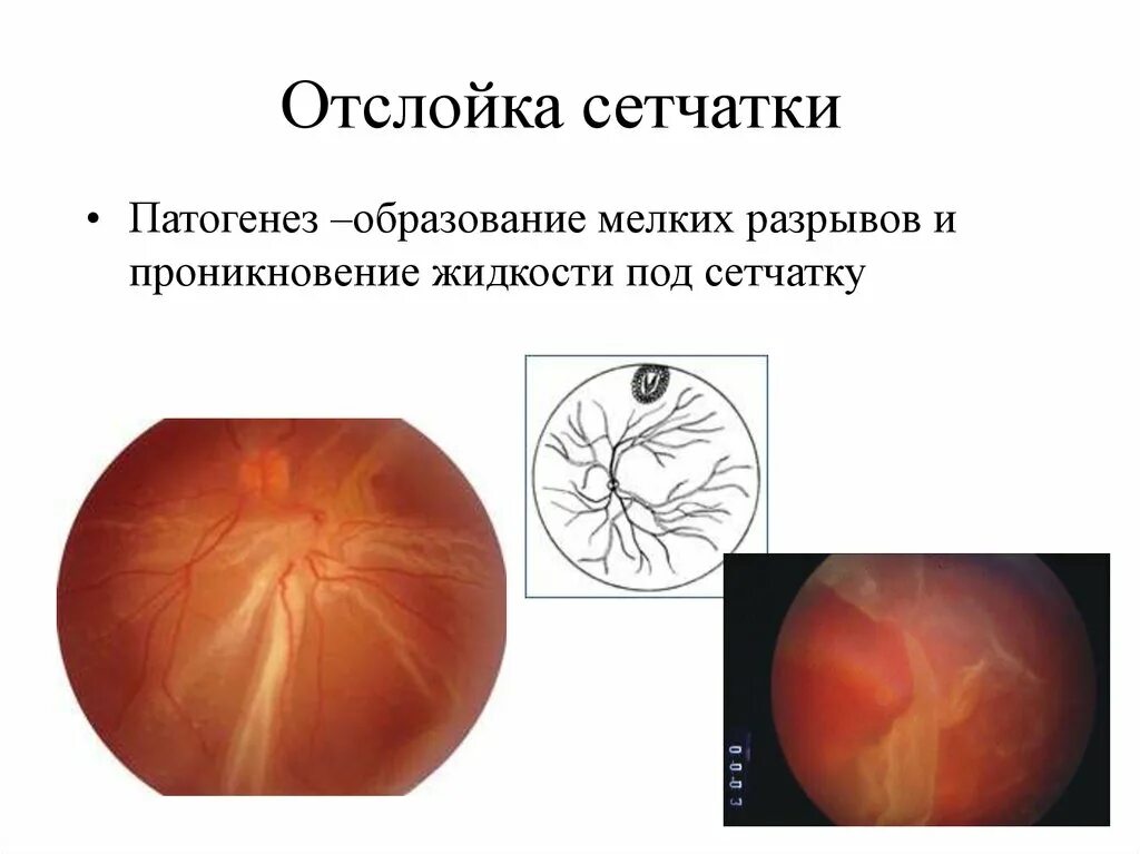 Глазное дно отслоение сетчатки. Регматогенная отслойка сетчатки глаза. Отслойка сетчатки этиология клиника. Регматогенная отслойка сетчатки симптомы.