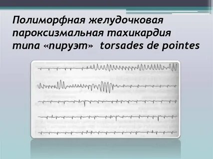 Полиморфная желудочковая