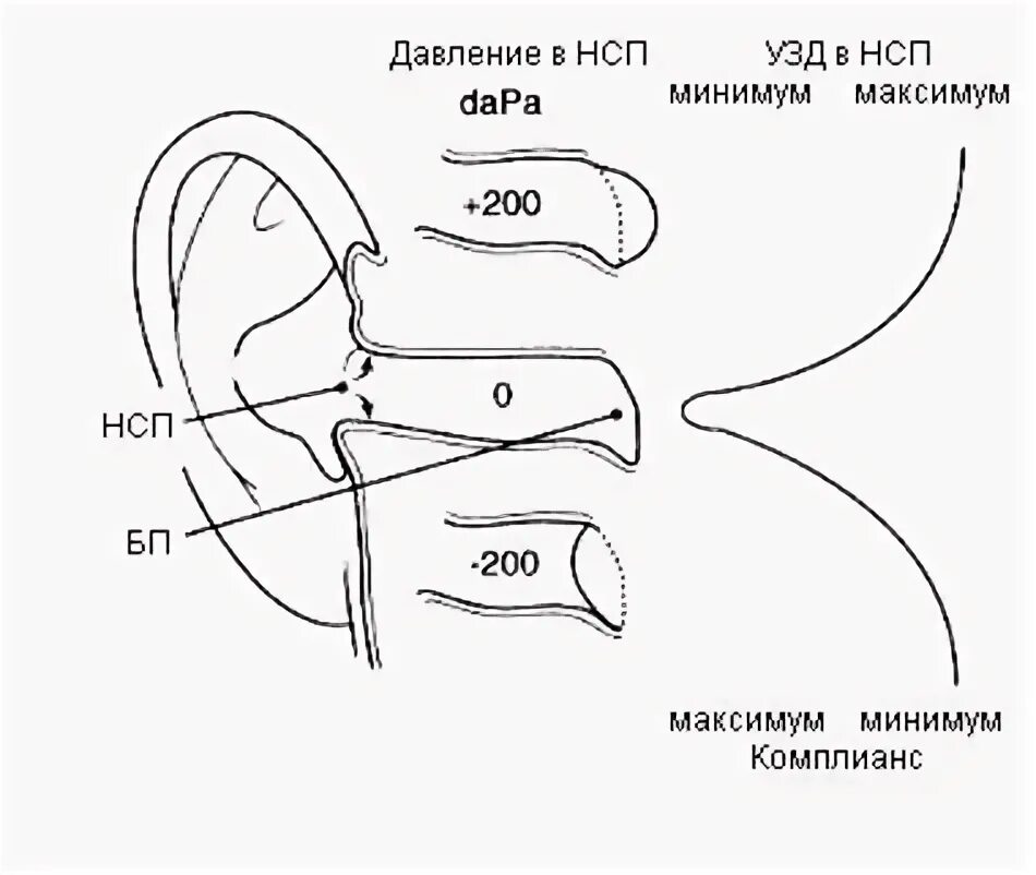 Давление в среднем ухе атмосферное. Рефлексометрия уха. Тимпанометрия с рефлексами. Импедансометрия уха. Тимпанометрия расшифровка результатов.