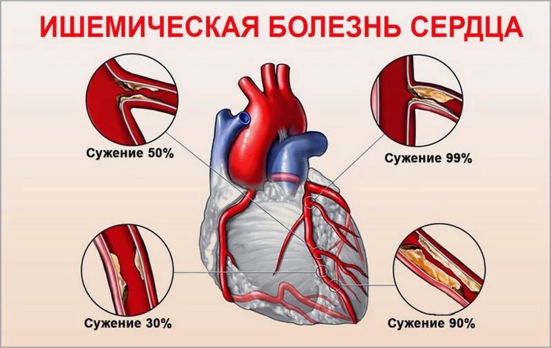 Ишемия у мужчин. Осложнения ишемической болезни. Проявления ишемической болезни сердца. Ишемическая болезнь сердца (ИБС).