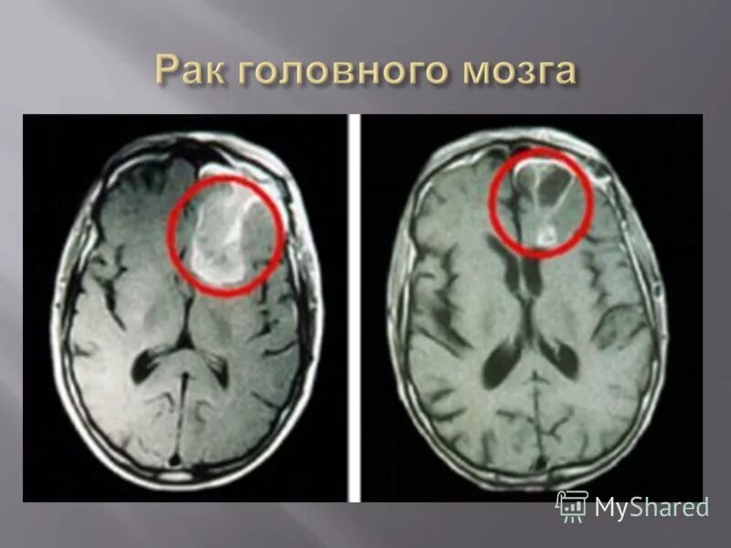 Симптомы опухоли головного мозга на ранних стадиях. Онкология глиобластома. Нейробластома головного мозга мрт. Диагноз глиобластома головного мозга.
