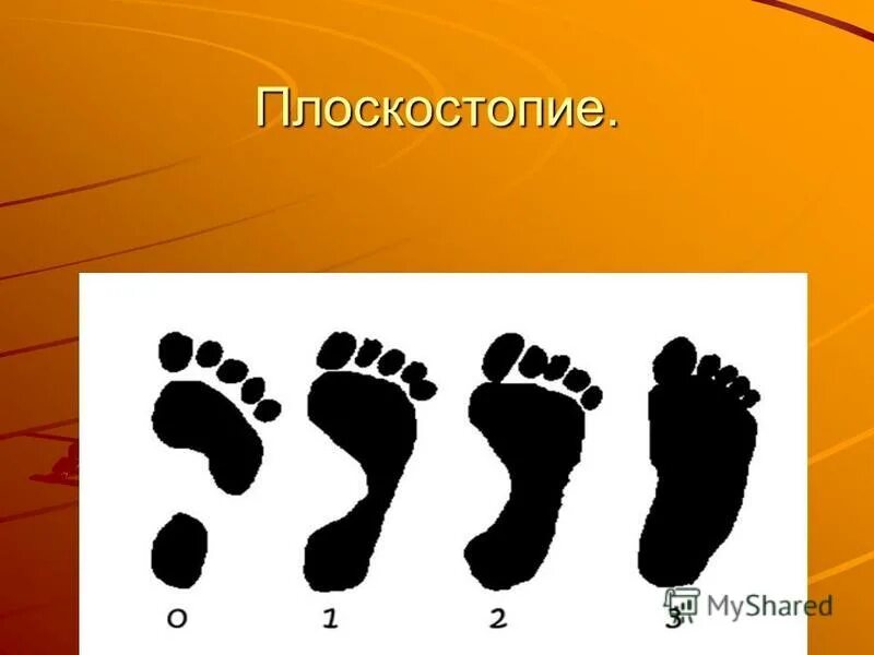 презентация на тему плоскостопие. плоскостопие по наследству. причины плоскостопия биология 8 класс. выявление плоскостопия по отпечатку стопы. плоскостопие у подростков.