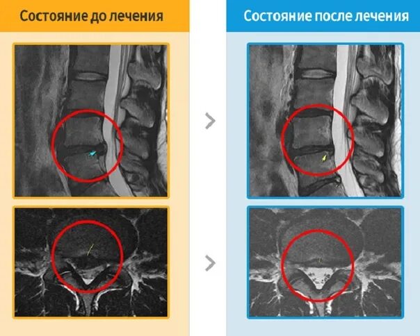 Грыжа диска поясничного отдела позвоночника мрт. Грыжа на мрт. Межпозвоночная грыжа мрт. Грыжа поясничного отдела мрт. Лечение позвоночной грыжи операция