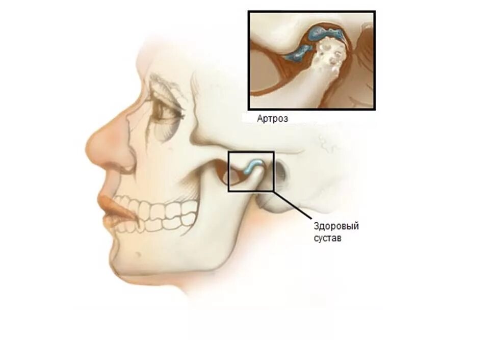 Боли костей лица. Артрит височно-нижнечелюстного сустава симптомы.