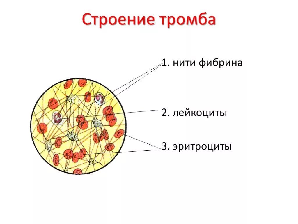 Образование тромба из фибрина