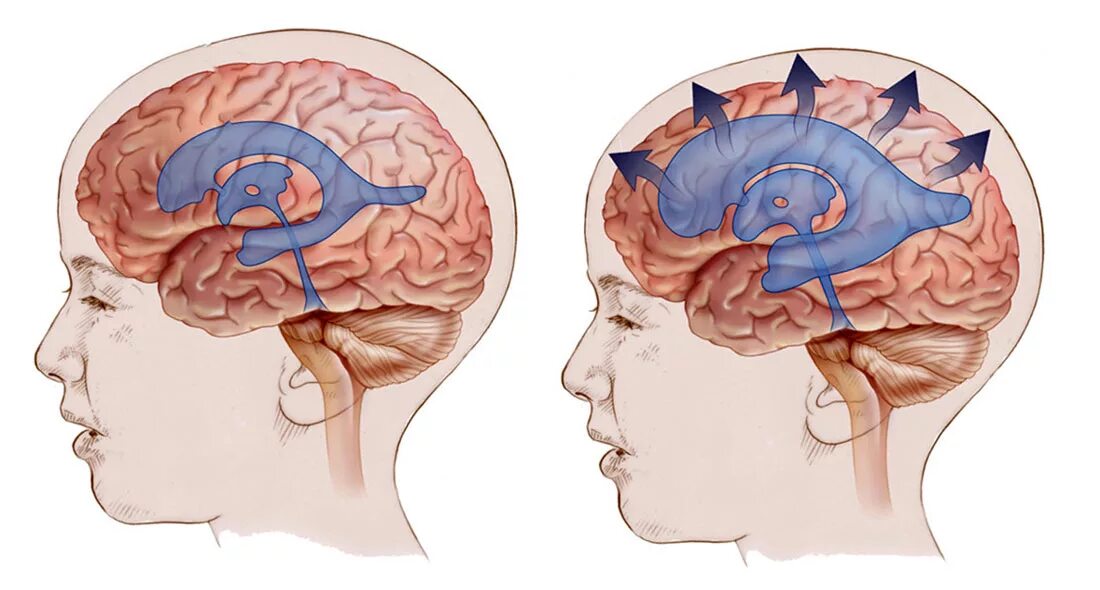 Водянка головного мозга ликвор. Гидроцефалия желудочков головного мозга. Желудочки головного мозга при гидроцефалии. Расширение желудочков мозга у ребенка
