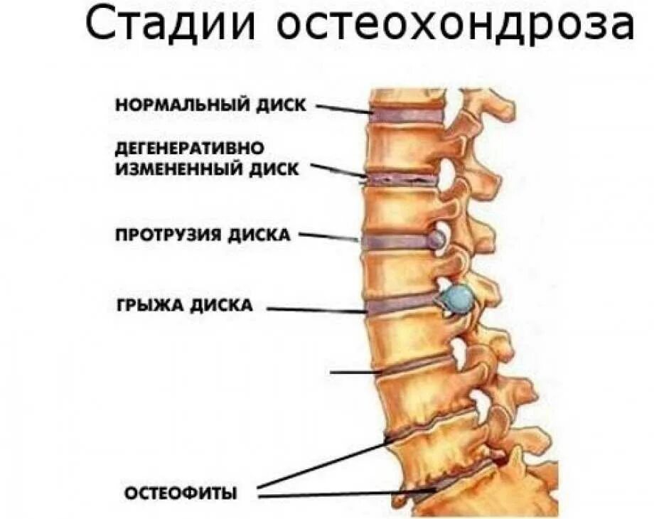Протрузии дисков спины. Грыжа позвоночника и протрузии межпозвоночных дисков. остеохондроз протрузии спондилоартроз поясничного отдела. остеохондроз поясничного отдела степени. протрузии дисков l3-l5.
