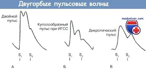 2 пульсовая волна