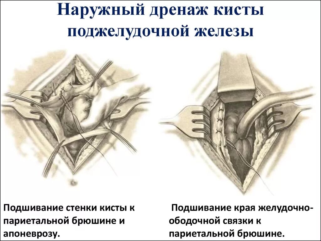 Делают ли операцию на поджелудочную. Наружное дренирование кисты поджелудочной железы на операции. Внутреннее дренирование кисты поджелудочной железы операция. Внутреннее дренирование поджелудочной железы операция. Резекция печени топографическая анатомия.