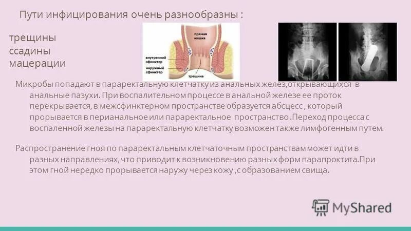 транссфинктерный свищ прямой кишки ( в анамнезе). подкожный парапроктит. свищи прямой кишки классификация. острый гнойный парапроктит классификация. острый парапроктит классификация.