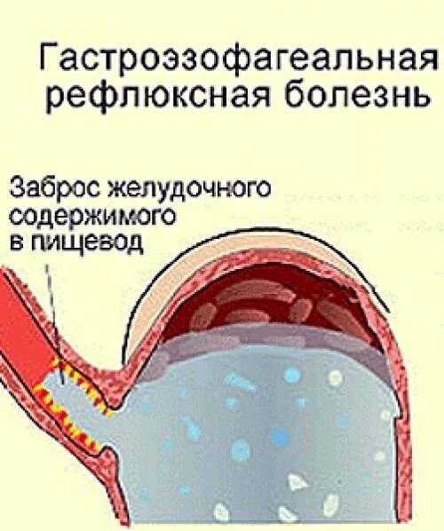 Заброс из пищевода в горло. Гастроэзофагеальный рефлюксная болезнь. Гастроэзофагеальная рефлюксная болезнь (ГЭРБ). Гастроэзофогальнаярефлюкснаяболезнь.