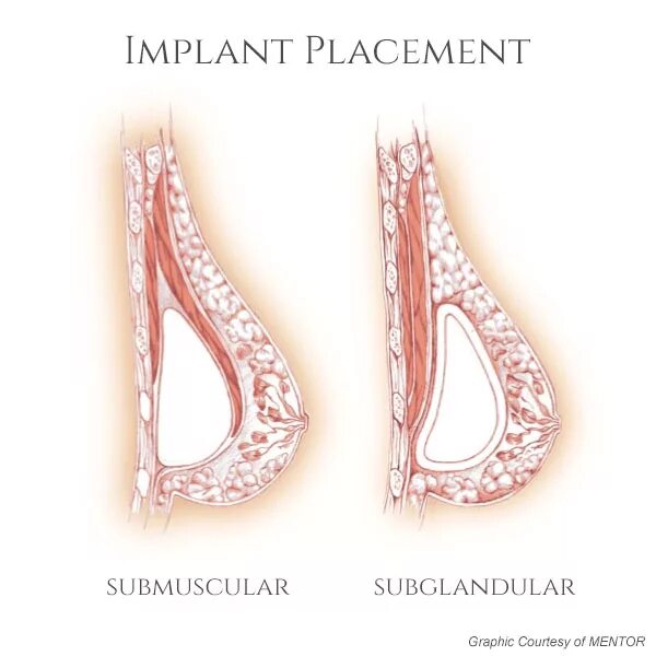 Увеличение груди через альвеолы. Серома увеличение груди. Риски увеличения груди. Implant Placement breast.