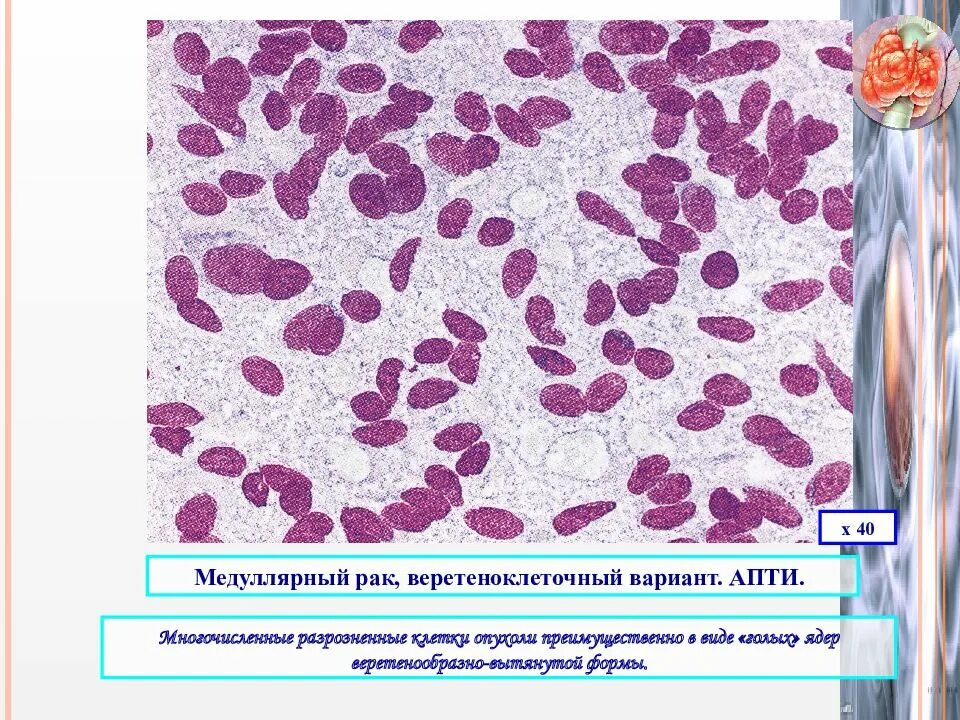 Медулярный рак. Медуллярная карцинома щитовидной железы. Карцинома щитовидной железы гистология. Медуллярная карцинома щитовидной железы гистология. Недифференцированная (анапластическая) карцинома.