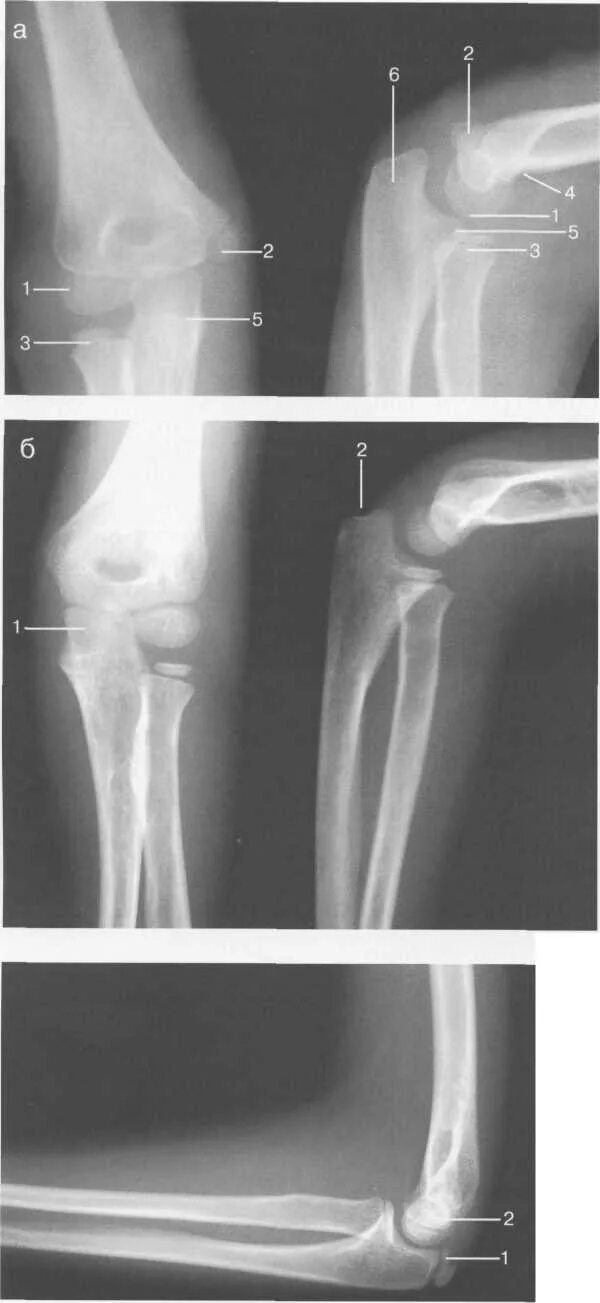 Локтевого мыщелка. Перелом мыщелка локтевой кости. Синовиома локтевого сустава рентген. Локтевой сустав отрыв плечевой кости. Апофиз локтевого отростка.