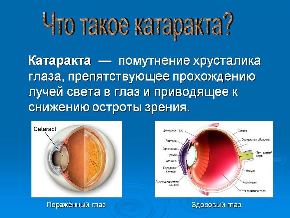Можно заменить хрусталик повторно. Заднекапсульная катаракта. миопизирующая катаракта. переднекапсулярная катаракта. хрусталик глаза.