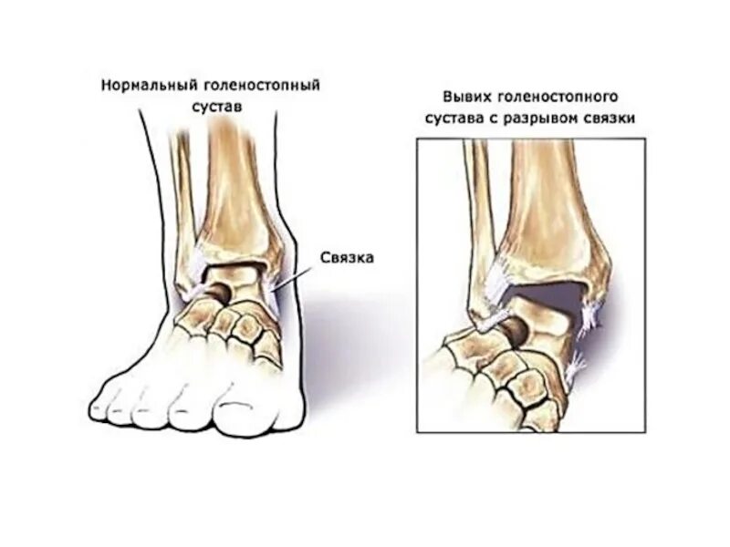 Частичный разрыв голеностопного сустава. Разрыв связки и перелом голеностопного сустава. Вывих сустава голеностопа. Подвывих голеностопного сустава симптомы. Ушиб голеностопного сустава классификация.