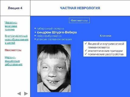 Склероз у детей